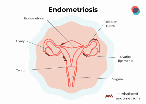 Endometriose EN-1 513