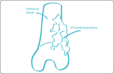 Sarcoma-1