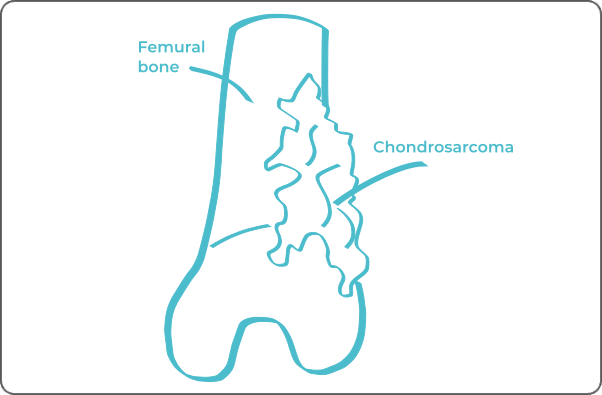 Labeled anatomical diagram of a sarcoma