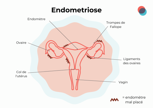 endometri 513