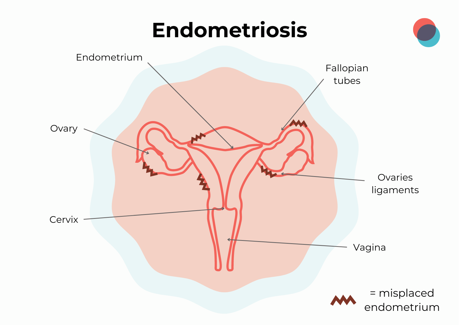 Endometriose EN-1